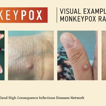 Monkeypox Visuals Crop